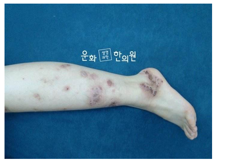 银屑病用什么药最好