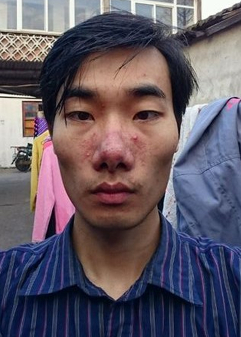 银屑病忌口大全