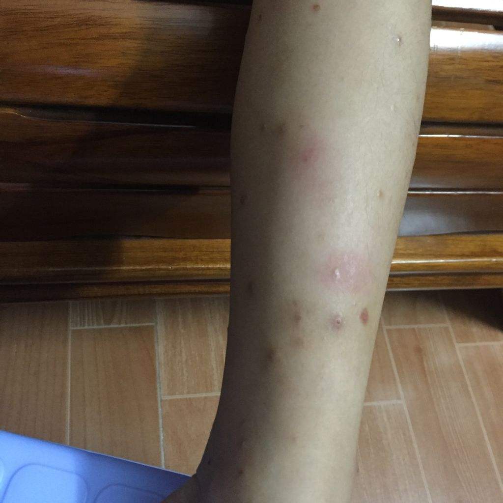 荨麻疹怎么治疗最快的方法