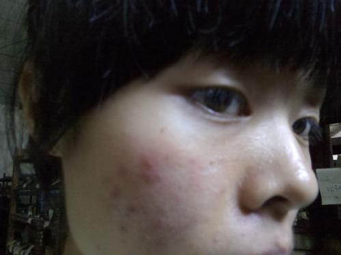 痤疮怎么治疗最彻底